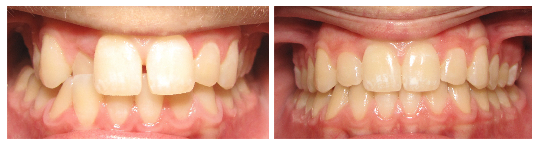 Invisalign1