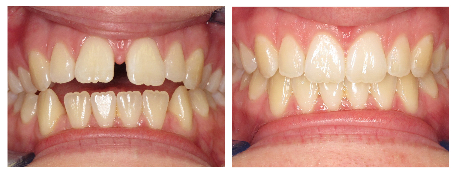 Invisalign1