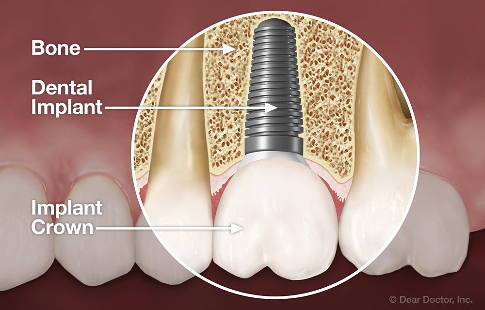 Dental implant anatomy
