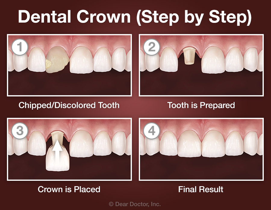 Crown step by step