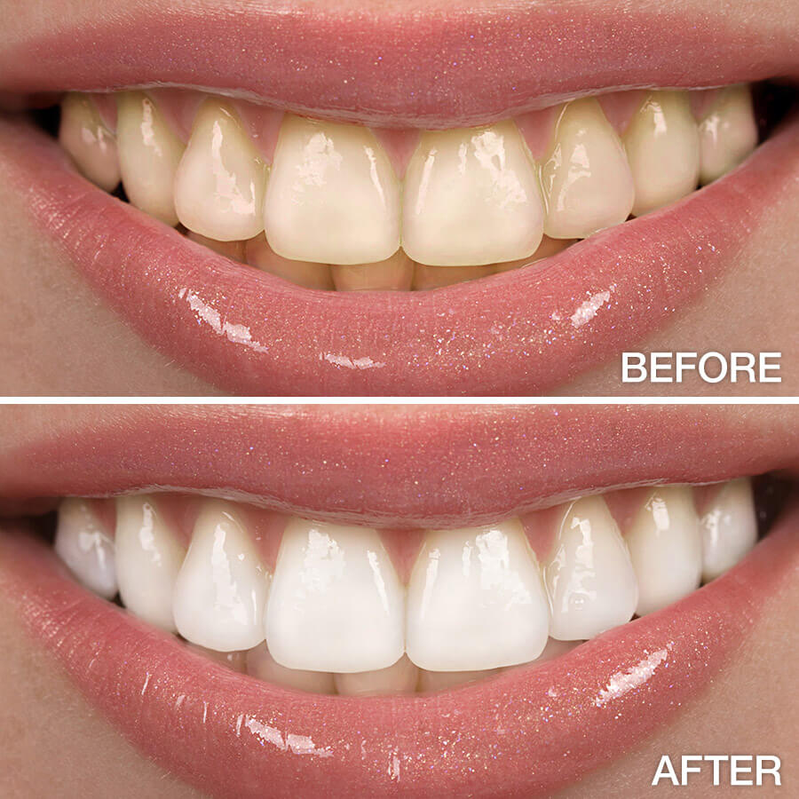 Before & after teeth whitening