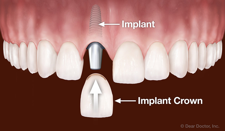 Implants replace one tooth