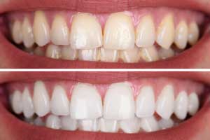 Before & after teeth whitening